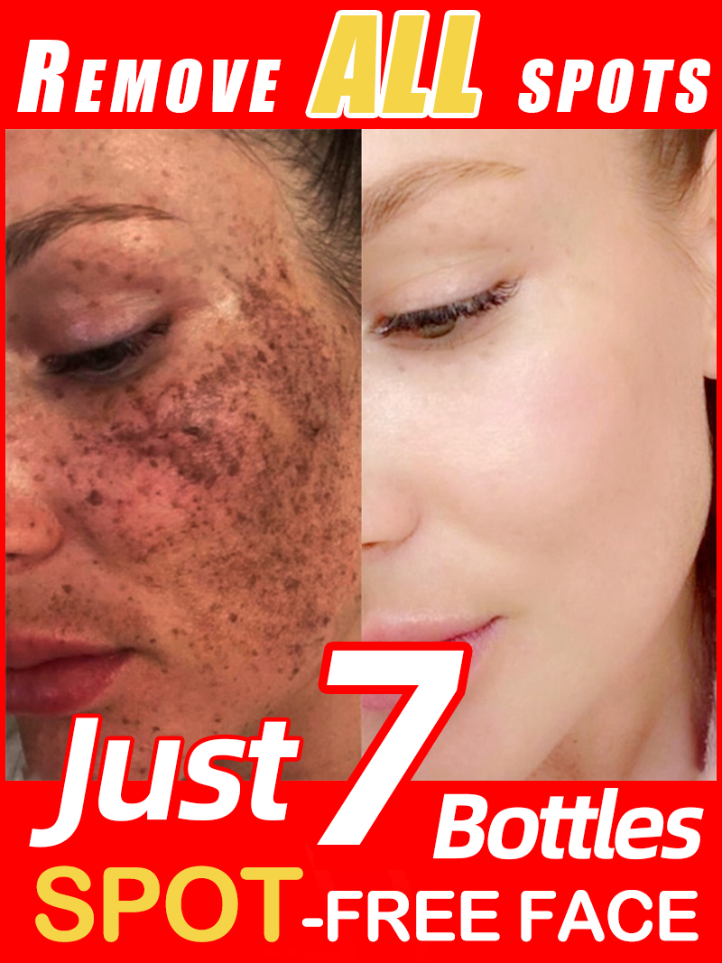 Erhellen Sie Sommersprossen Me – Luxury Natural Skincare Bewertung und Preis